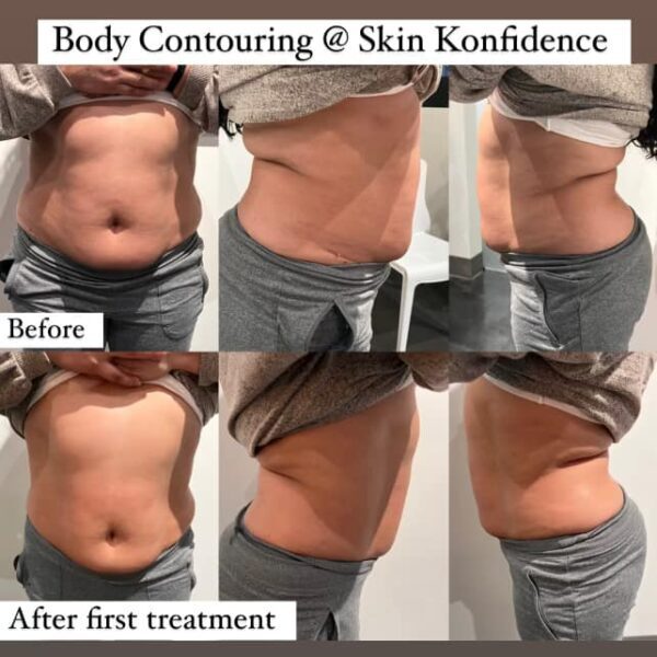 Body-Contouring-e1735241875744