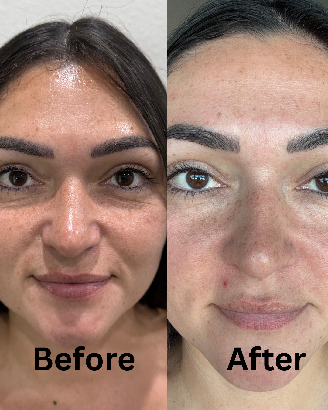 Tixel skin rejuvenation
